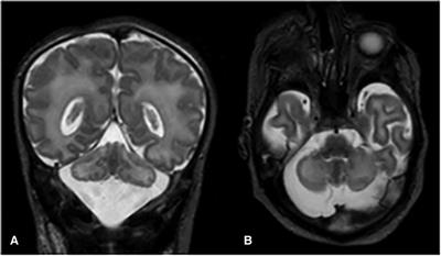 A novel homozygous variant in SLC25A46 gene associated with pontocerebellar hypoplasia type 1E: a case report